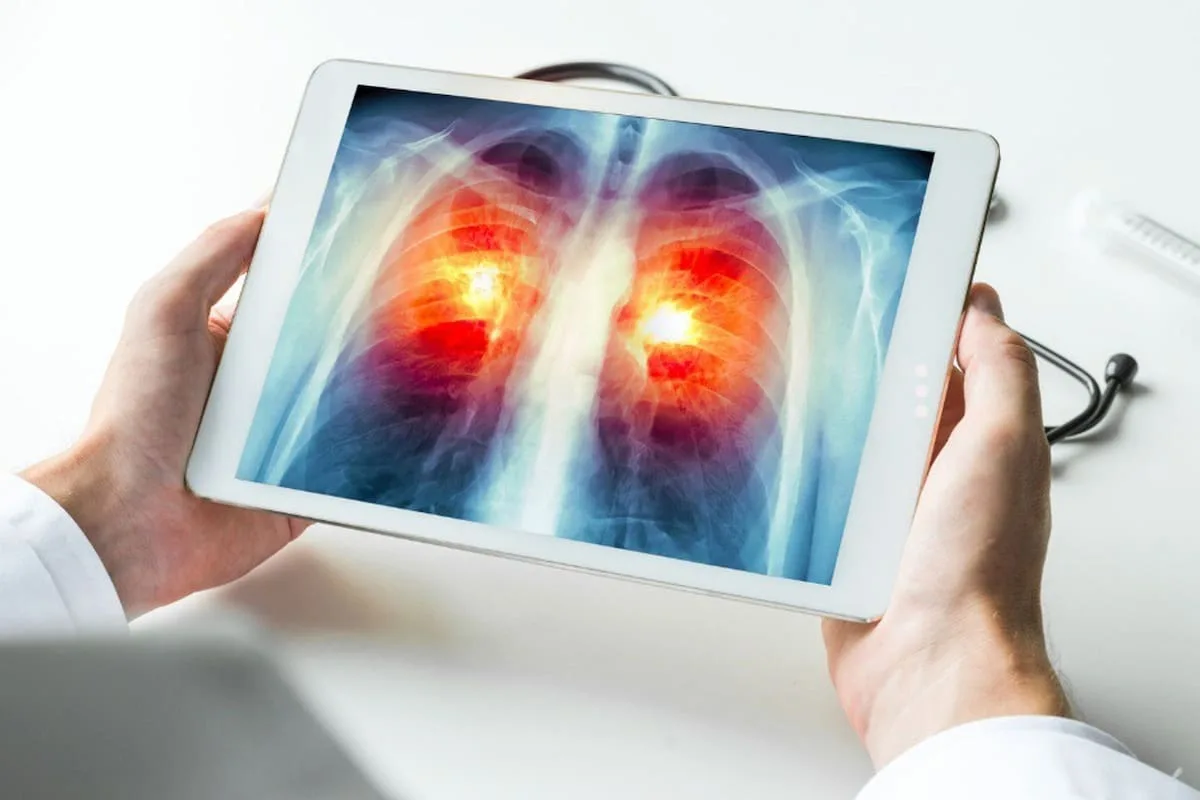 Cáncer de pulmón: cuáles son sus síntomas, factores de riesgo y cómo prevenirlo