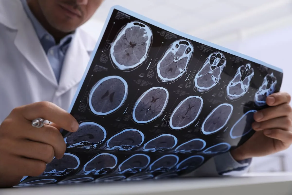 Un método con IA detecta lesiones cerebrales ocultas en esclerosis múltiple
