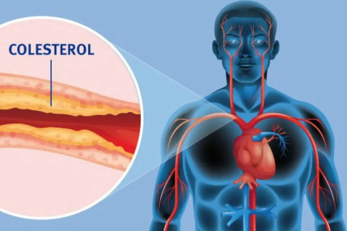 Una infusión de edición genética reduce el colesterol de forma permanente